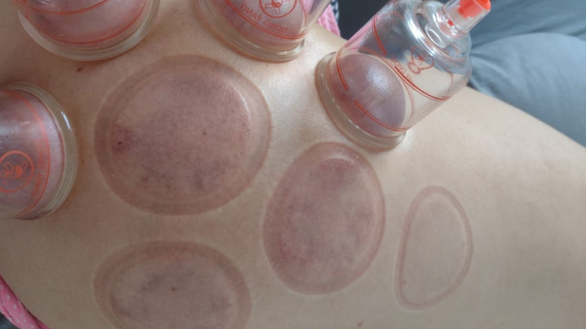 Fisioterapeuta da Fisiome realiza atendimento domiciliar em Boa Viagem, Recife, aplicando ventosas de acrílico na região dorsal e ombros de uma paciente deitada confortavelmente na sala de sua residência para alívio de nós de tensão.