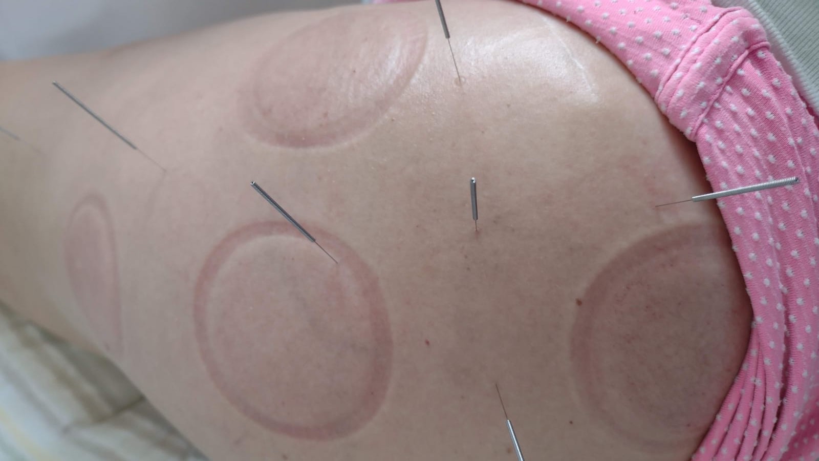Fisioterapeuta da Fisiome realiza atendimento domiciliar em Boa Viagem, Recife, aplicando com precisão a técnica de dry needling (agulhamento a seco) nos músculos do trapézio e ombro de uma paciente confortavelmente acomodada em sua residência para alívio da dor.
