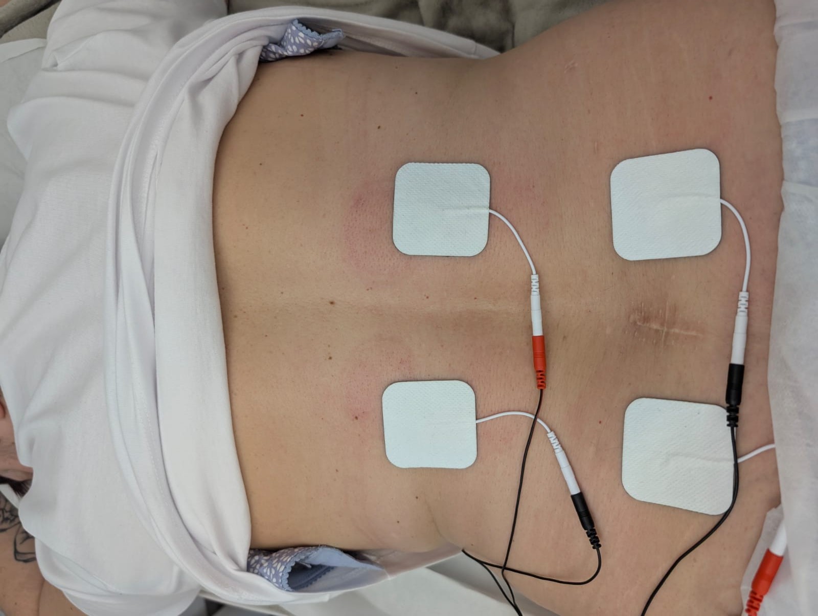 Fisioterapeuta da Fisiome realiza atendimento domiciliar em Boa Viagem, Recife, aplicando eletrodos de um aparelho TENS na região lombar de uma paciente confortavelmente deitada na sala de sua residência para alívio da dor.